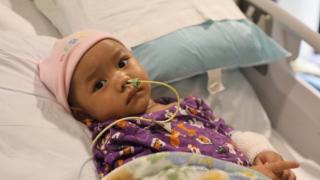 Young burn patient from nepal, Young burn patient, patient finds new home, nepalese burn patient, icu patient, excellence in burn care