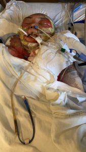 In Burn Icu, pam garcia cruz, burn patient, burn center, trauma care for burns, healing center for burn victims