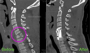 xray of neck, spinal cord injury, diving accident, nick maestas, minnesota Level 1 trauma center, dr uzma samadani, spinal fracture, neurosurgeon