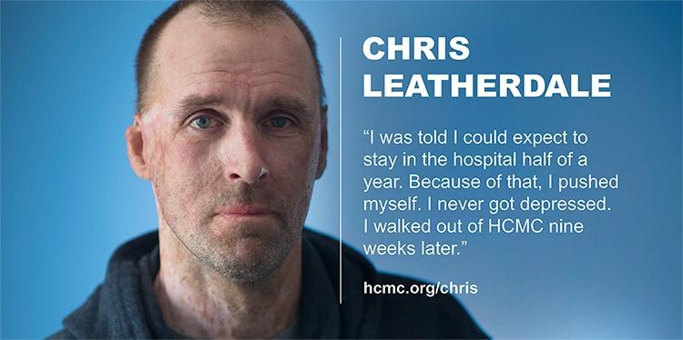 rehabilitation for burns, chris leatherdale, laser surgery for burns, rehab center for burn patients, burn patient, miland e knapp rehabilitation center